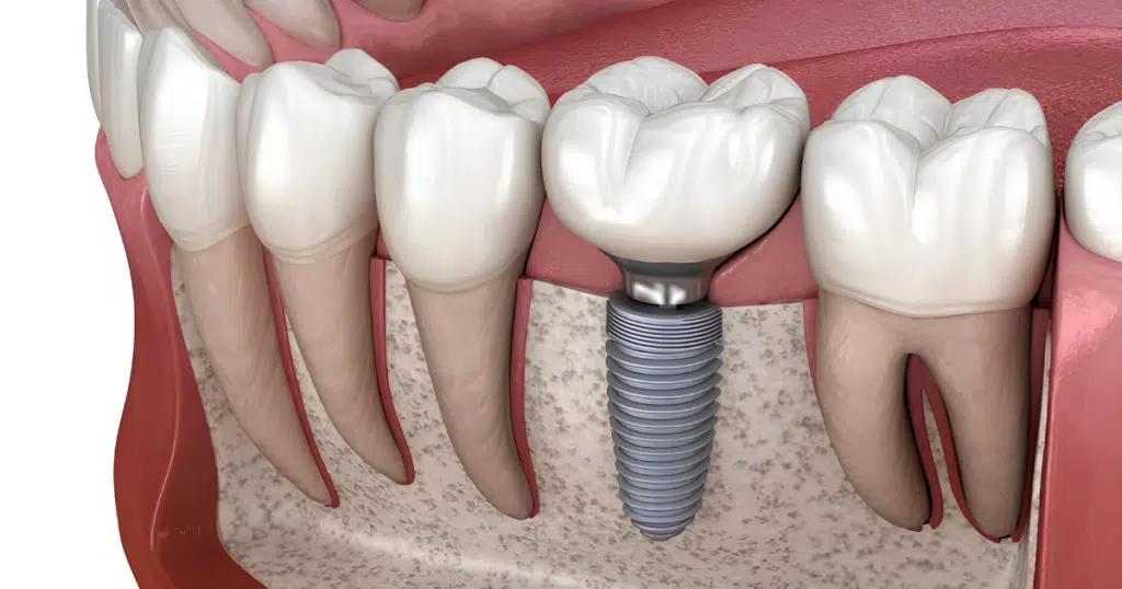 Dental Implants - Siebenthaler Dental - featured image