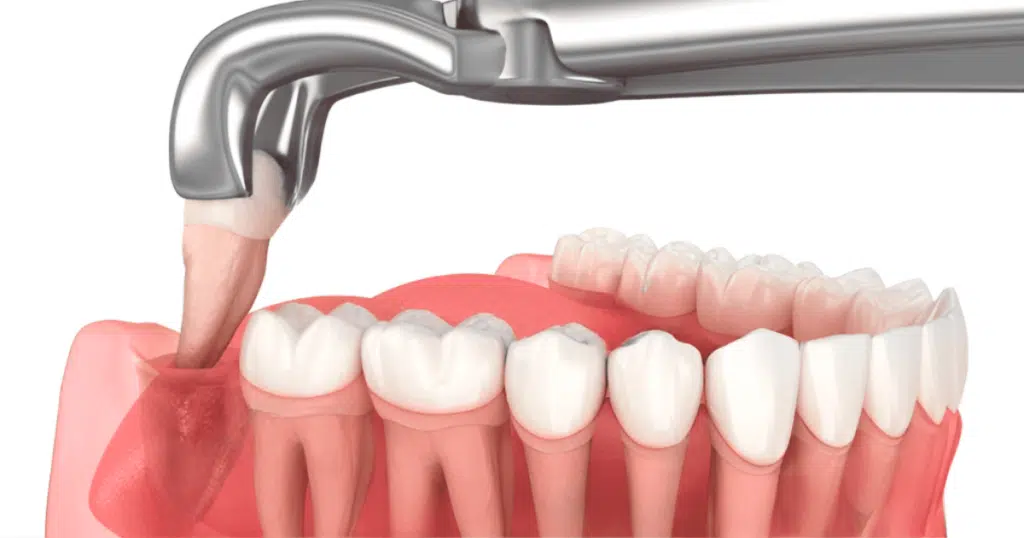 Extractions - Siebenthaler Dental- featured image