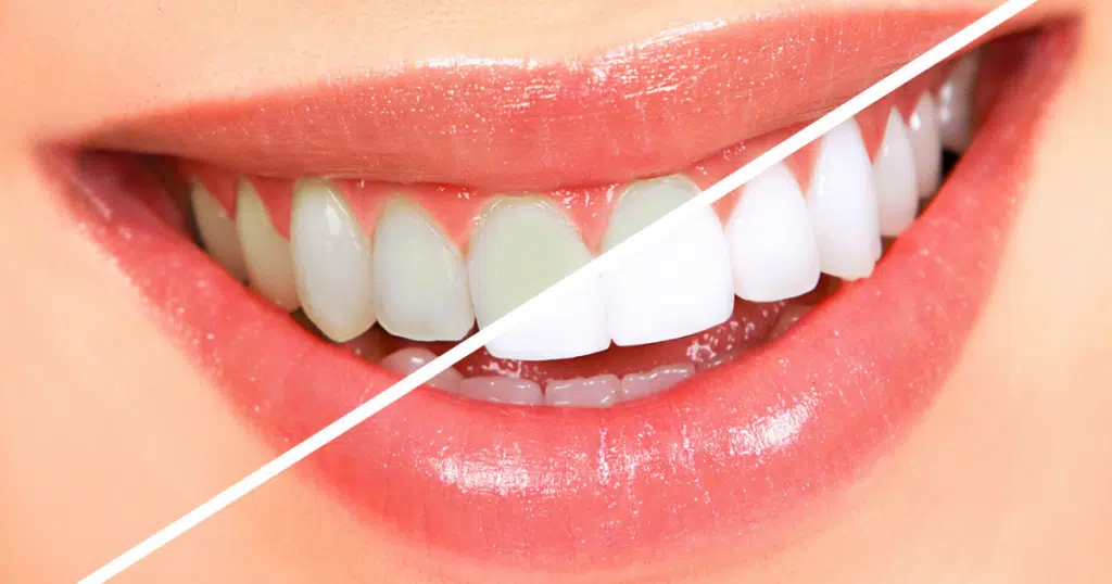 Teeth Whitening - Siebenthaler Dental - featured image