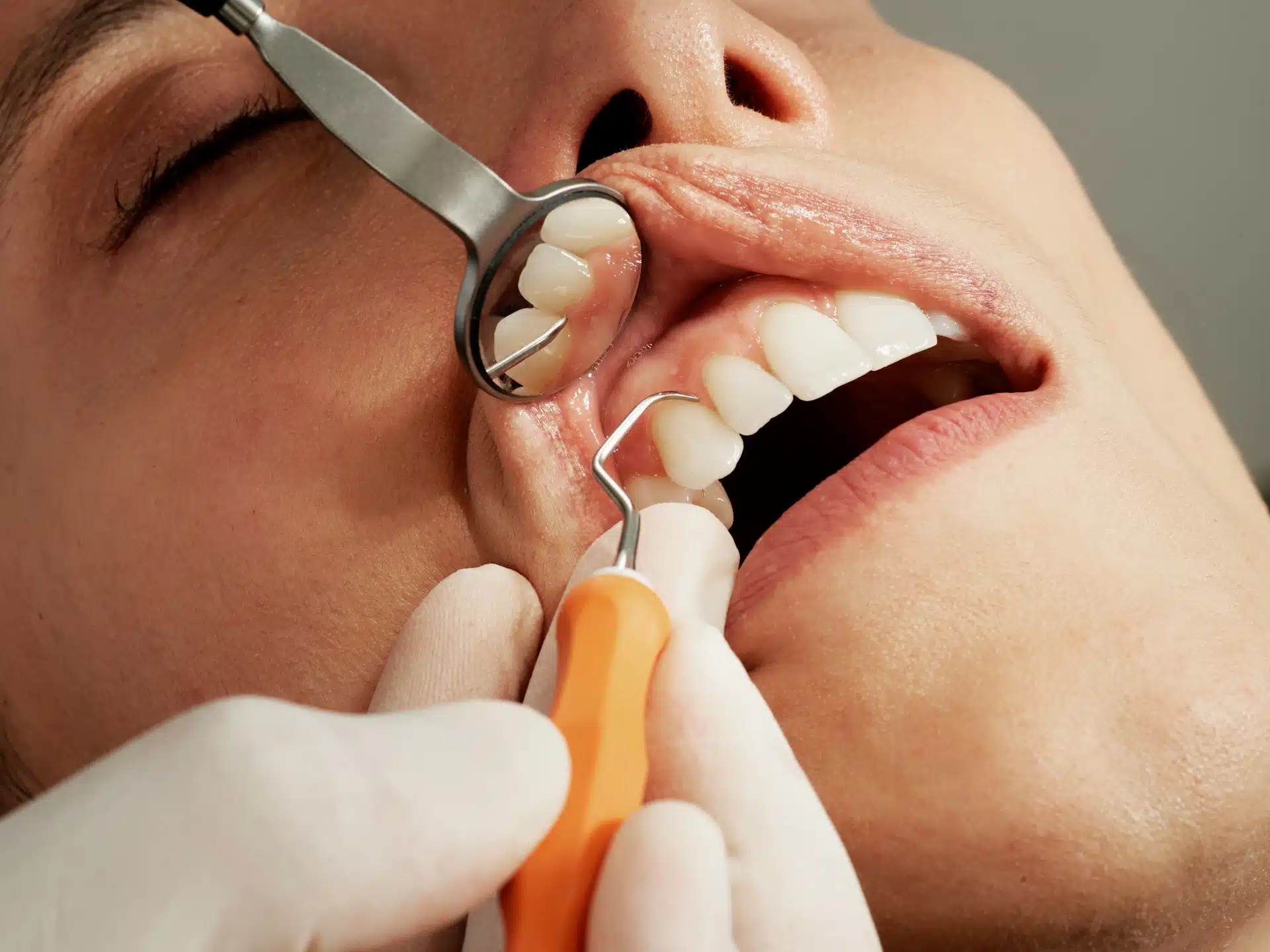 dental cleaning